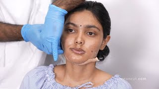 Face Change After Plastic Surgery in India Jaw Surgery Before And After Results [upl. by Aitnohs680]