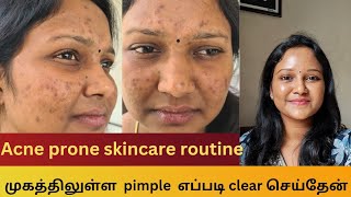 How I cleared my acne  Acne prone skincare routine  Products that I used for acne acneproneskin [upl. by Cooperstein]