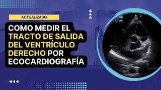 🏅Cómo medir el TRACTO DE SALIDA DEL VENTRÍCULO DERECHO TSVD por ecocardiografía Actualizado [upl. by Wilhide]