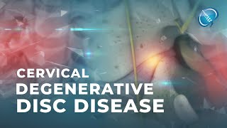 What is Cervical Degenerative Disc Disease  DDD [upl. by Enayd]