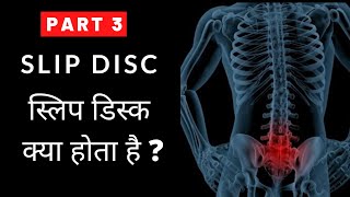 Slipped Disc in Lower Back Part 36 स्लिप डिस्क क्या होता है [upl. by Aniham]