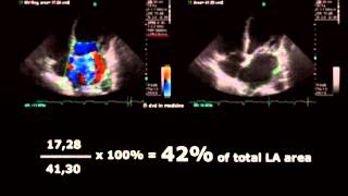 Volodymyr Pavliuk MD PhD Echocardiographic Assesment of Mitral Regurgitation [upl. by Suriaj]