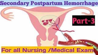 Secondary Postpartum HemorrhageIIPART3II Management of SecondaryPPH IINightingale Nursing Academy [upl. by Baynebridge427]