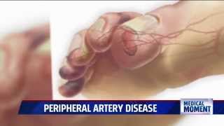 Symptoms and Treatments for Peripheral Artery Disease PAD [upl. by Tomas]