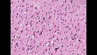 Histopathology BrainAstrocytoma [upl. by Narcho932]