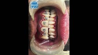 Class 2 div 1 Malocclusion  BRACES trending dentist toothdental dentalcare dentalclinic tooth [upl. by Swiercz162]