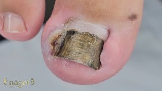 😯INACREDITÁREL ESSA RECUPERAÇÃO nails ingrowntoenail [upl. by Ahsem663]