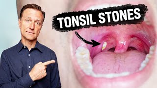 What CAUSES Tonsil Stones and How to Prevent Them [upl. by Otti]