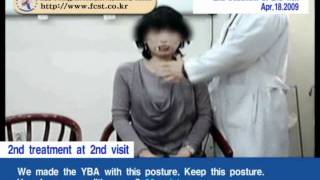 Torticollis Cervical Dystonia [upl. by Obeded]