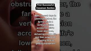 The First Successful Cesarean Section in History shorts [upl. by Gunning]