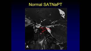 Journal Club Sagittal Angle in Trigeminal Neuralgia [upl. by Shabbir]