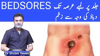 BEDSORES PRESSURE ULCERS زیادہ دیر تک دباؤ کی وجہ سے ھونے والے زخم [upl. by Kimbell]