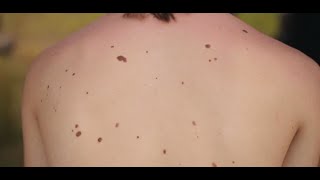 Dermatologist shares warning signs of melanoma [upl. by Anyar]