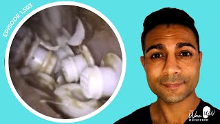 1503  TOP 10 MOST BIZARRE FOREIGN BODY EAR EXTRACTIONS 🫣 [upl. by Arykat468]