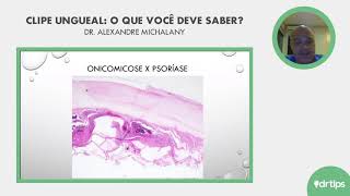 LIVE  Patologia dos Anexos  Clipe Ungueal O que você deve saber [upl. by Eniamart308]