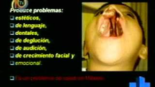 LABIO Y PALADAR HENDIDOmp4 [upl. by Coward]