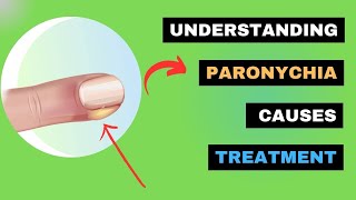 Paronychia Explained How to Spot Treat and Prevent Nail Infections  SWOLLEN TISSUE around Nails [upl. by Arolf]