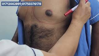 পুরুষের বড় স্তনের চিকিৎসা। Gynecomastia Surgery in Bangladesh [upl. by Atnoved305]