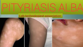 What is Pityriasis Alba The causes and treatment of pityriasis Alba [upl. by Irneh527]