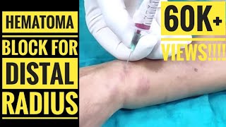 Haematoma Block for Distal Radius Fracture [upl. by Noslen939]