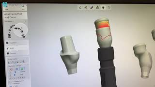 Custom locator abutments [upl. by Rudolph567]