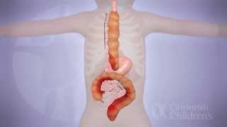 LongSegment Colonic Interposition for Esophageal Atresia 3D Animation [upl. by Glantz]