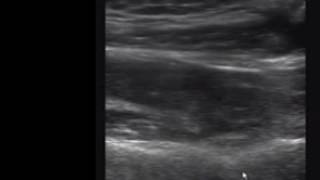 Suprascapular Nerve Block [upl. by Aviv]