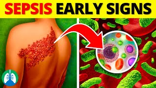 Top 10 Early Warning Signs of Sepsis  NEVER Ignore THIS [upl. by Aihsiek535]