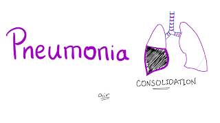 Pneumonia [upl. by Emeline]