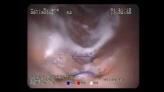 Pentax K Series Gastroscope Video Example [upl. by Roanna81]