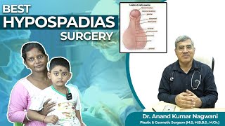 Hypospadias  প্রস্রাব সঠিক জায়গায় না খোলার সমস্যা  Hypospadias Repair in India  Dr Nagwani [upl. by Gaskin]