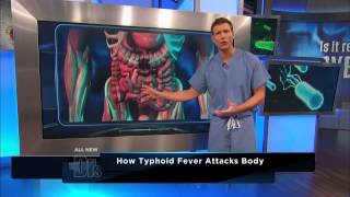 How Typhoid Fever Affects the Body  The Doctors [upl. by Einwahs]