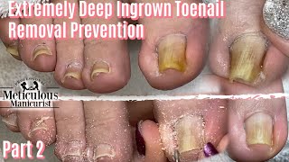 Salon Pedicure Big Toe Pain Ingrown Toenails Cleaning Transformation Part 2 [upl. by Otilia]