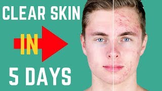 How to REALLY Get Clear Skin In 5 DAYS [upl. by Asiul]