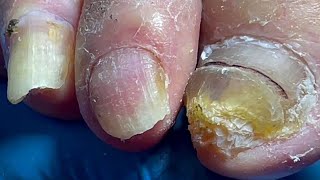 Onychomycosis infected the whole foot professional pedicure master【Pedicure Master Lin Jun】 [upl. by Erdied580]