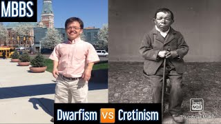 Dwarfism 🆚 Cretinism Differences MBBS NEETPG [upl. by Miett]