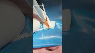 Root canal treatment amp composite restoration dentist [upl. by Donnie851]