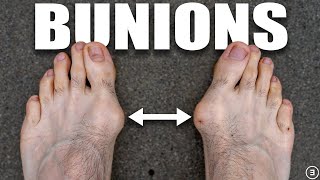 Bunions  Hallux Valgus Diagnosis Exercises Treatment [upl. by Paugh]