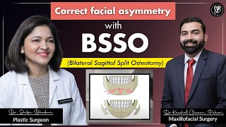 Correction of Misaligned Jaw amp Facial Asymmetry  Bilateral Sagittal Split Osteotomy BSSO Surgery [upl. by Crispas]