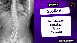 Scoliosis  Types Pathology Clinical Features  Orthopedic deformity  Sedative Physio [upl. by Fransis]