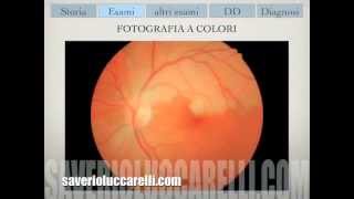 Sindrome di Susac Retinica Retinal Susac Syndrome [upl. by Tortosa]