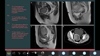 Carcinosarcoma Cérvico Uterino [upl. by Ahsenyl796]