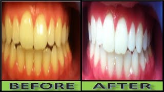 How to Turn Yellow Teeth to White Teeth In 2 Minutes Naturally at Home [upl. by Coke]