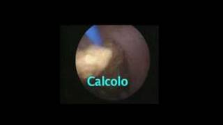 Ureteroscopy endoscopic treatment for ureteral stones [upl. by Nicole]