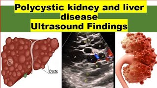 Polycystic kidney and liver disease ultrasound findings [upl. by Ydnagrub]