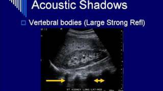 Physics of Ultrasound Image Artifacts Segment 5 [upl. by Belen]