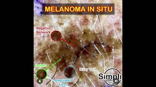 Melanoma in situ Dermoscopy [upl. by Dearman248]