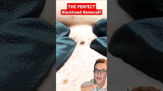 Crazy Huge BLACKHEAD REMOVAL  This Is Perfect shorts [upl. by Paco731]