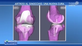 Artrosi al ginocchio una nuova cura [upl. by Bevis]