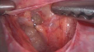 Uterine Artery Ligation Clipping  Anterior and Posterior Approach [upl. by Donelle342]